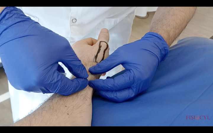 " Cursos fisioterapia online - app Fisiocyl neuromodulación" 