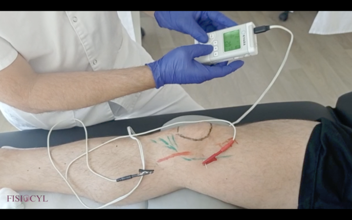 curso electropunción y neuromodulación Fisiocyl